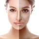 Antes y después de tratamiento antimanchas en la cara