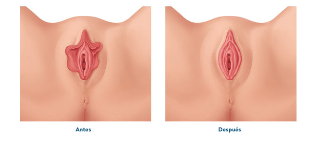 Antes y después de intervención por hipertrofia de labios menores