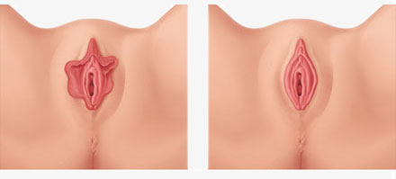 Antes y despues de cirugia intima femenina