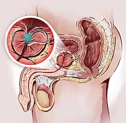 Esquema de biopsia de próstata