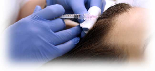 Terapia capilar con factores de crecimiento plaquetario contra la pérdida del cabello