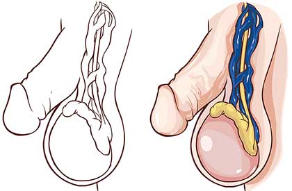 Dilatación de venas en testículos
