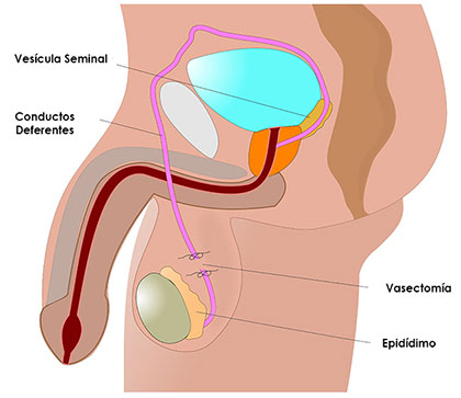 Esquema de vasectomia