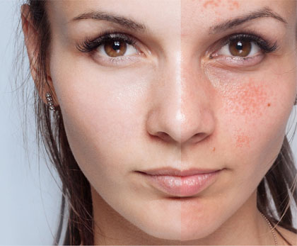 Antes y después de tratamiento con Dermamelan para manchas de la piel