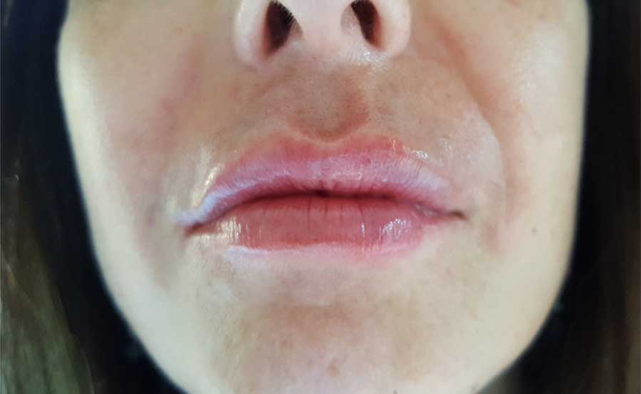 Después de relleno de labios